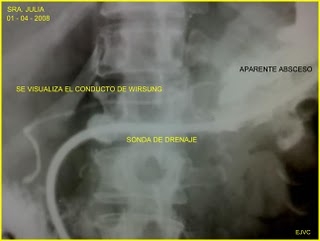 imagini fistula panreatica